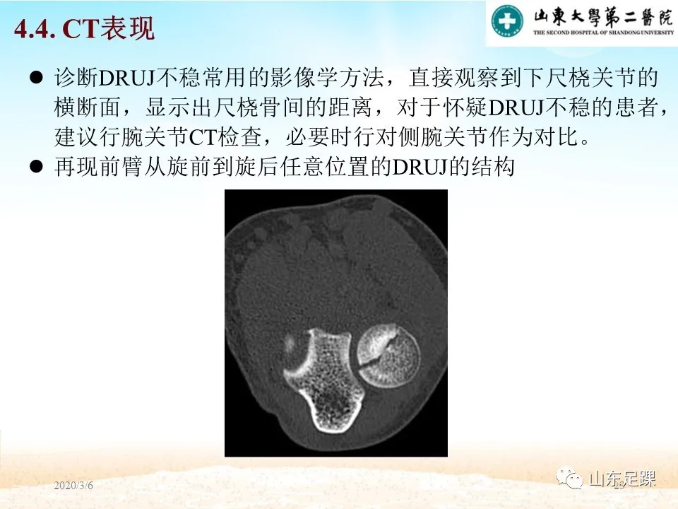 远端尺桡关节（DRUJ）不稳定的诊断与解剖重建 - 图23