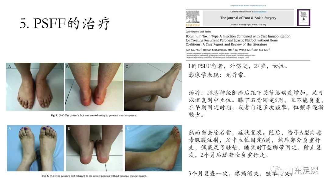 腓骨肌痉挛性平足 - 图15