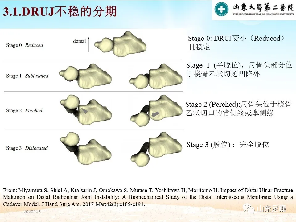 远端尺桡关节（DRUJ）不稳定的诊断与解剖重建 - 图14