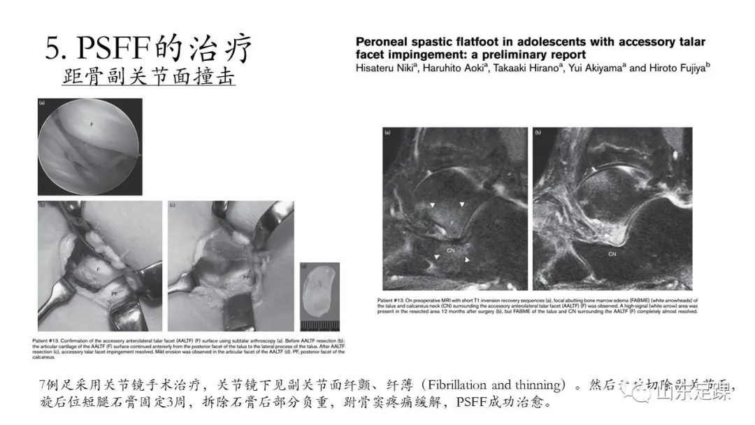 腓骨肌痉挛性平足 - 图13