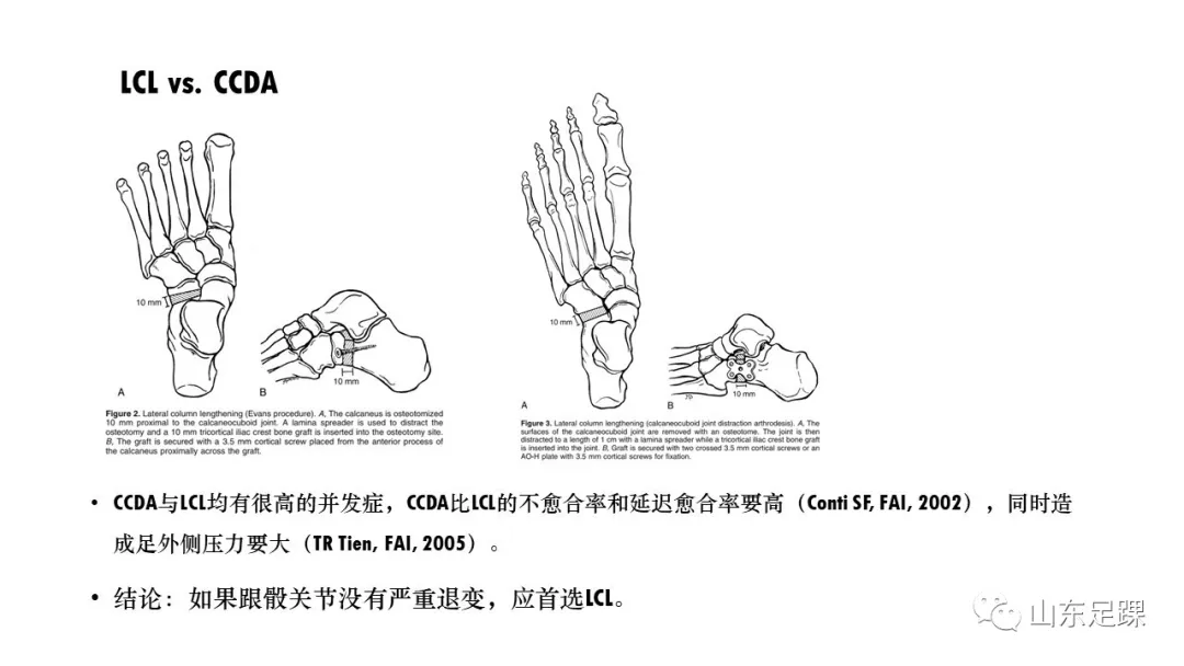 成人获得性平足-概述 - 图32