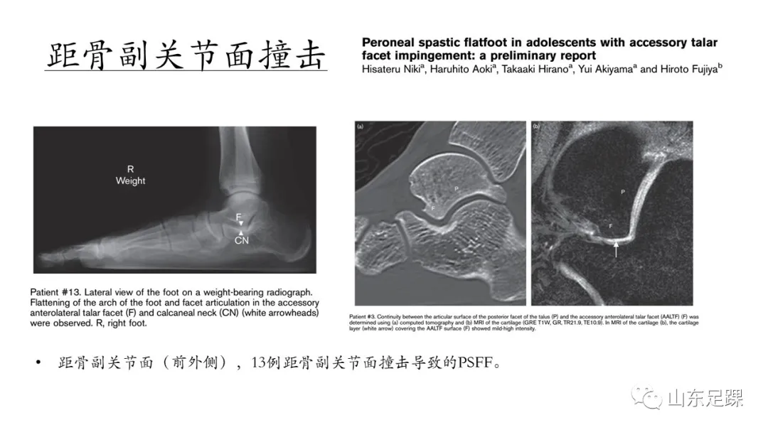 腓骨肌痉挛性平足 - 图7