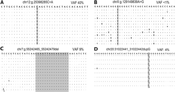 Figure2 Alignment views of four variants detected by NGS. Each panel depicts a representative set of variant reads for single nucleotide variant (A and B) or insertion/deletion variants (C and D) with either high quality (A and C) or low quality (B and D). The human genome reference sequence is the string of bases along the top of each panel. Aligned basecalls matching the reference are listed as dots (plus strand) or commas (minus strand). High quality variants typically have higher variant allele frequencies (VAF), and variants reads have fewer additional variants. Panel D depicts known false positive locus, likely due to the "homopolymer problem" where certain NGS technologies overcall insertion/deletion variants where the reference sequence has five or more of the same nucleotides in a row (in this case, 8 guanines).